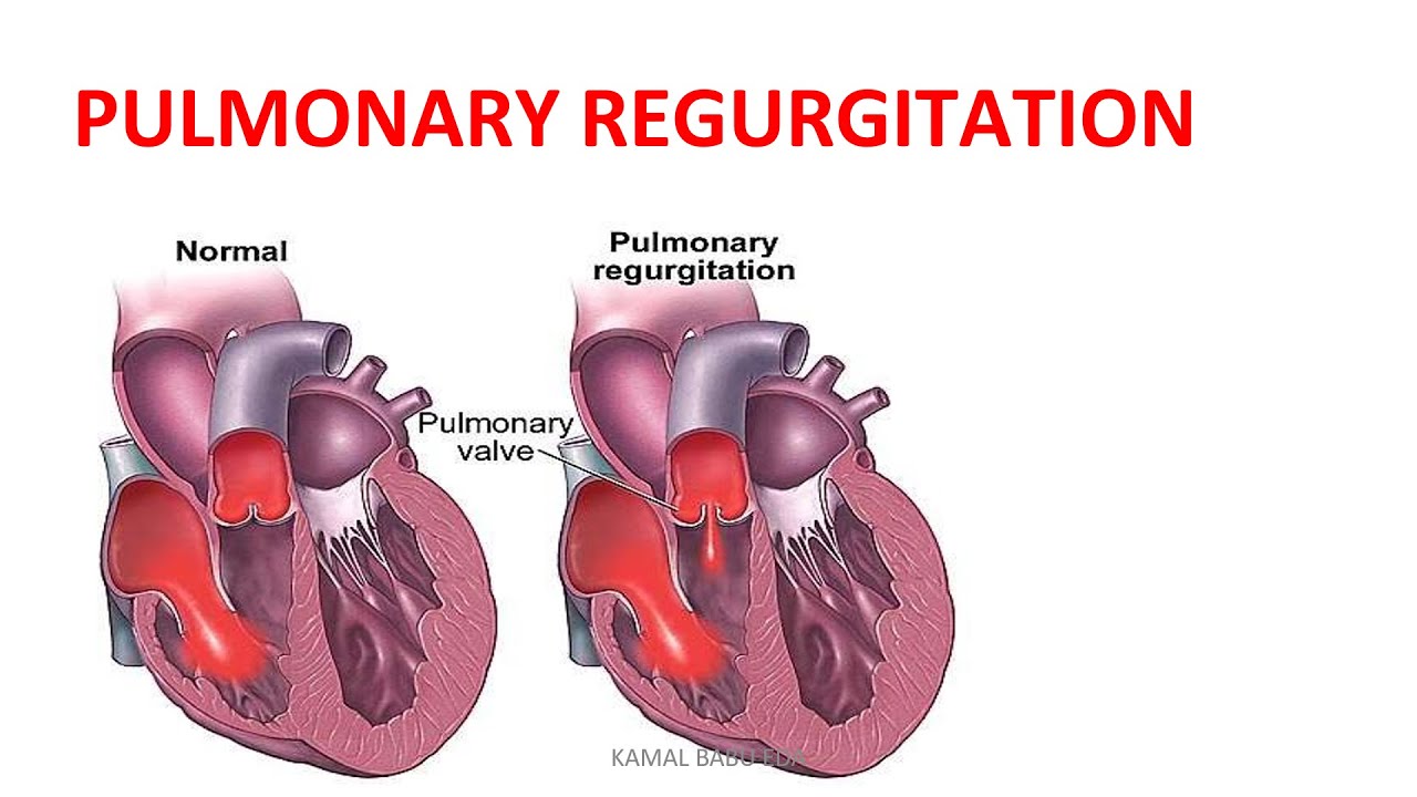 pulmonary valve