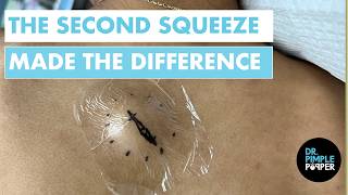 The Second Squeeze Made The Difference | Epidermoid Cyst Removal