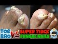 Trimming of Super Thick Fungal Nails: FULL TREATMENT