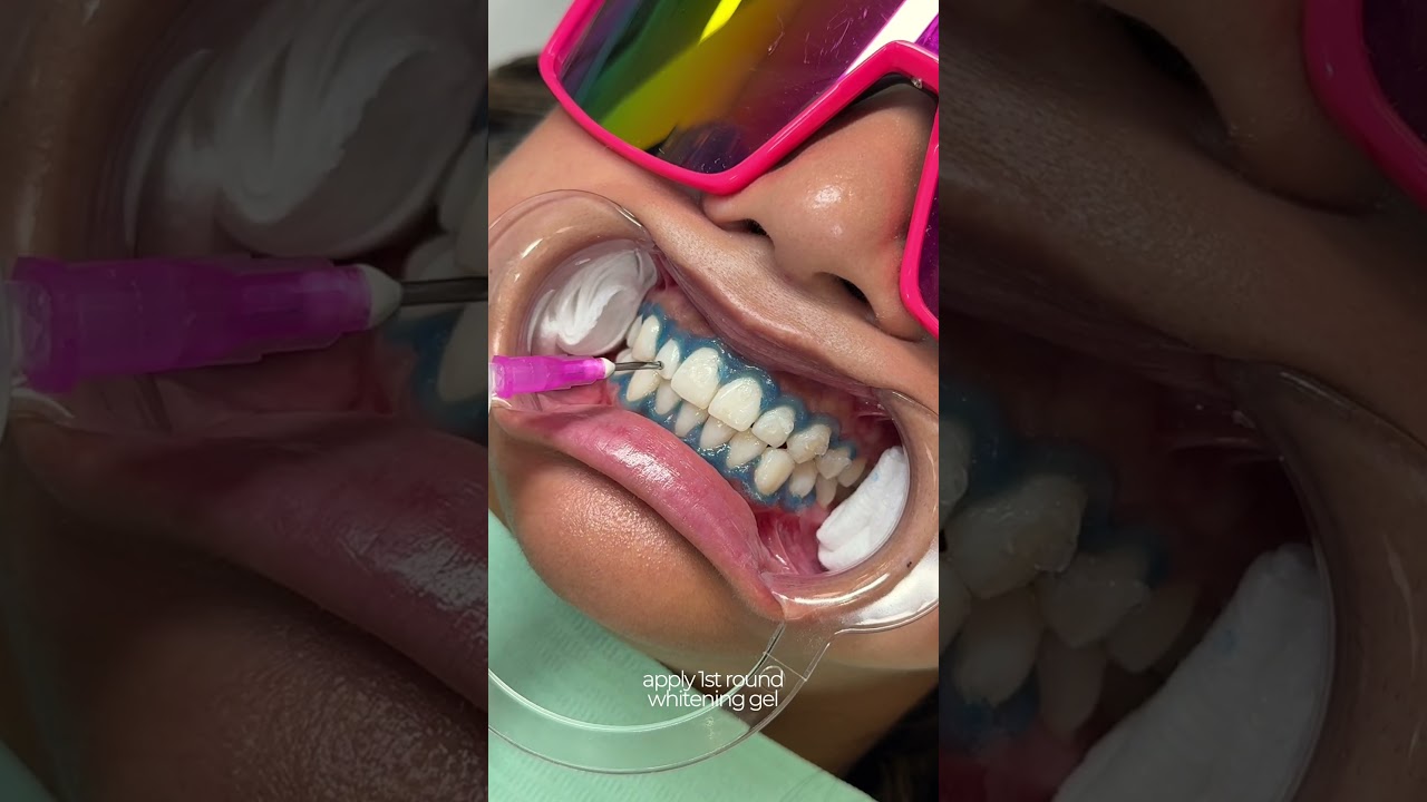 teeth whitening transformation 🦷 
