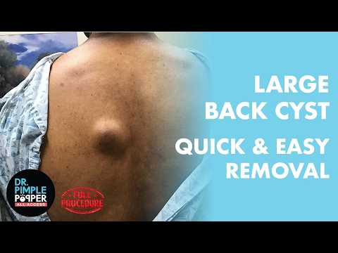 FULL PROCEDURE | Dr. Pimple Popper vs. The Large Back Cyst | All Access Exclusive
