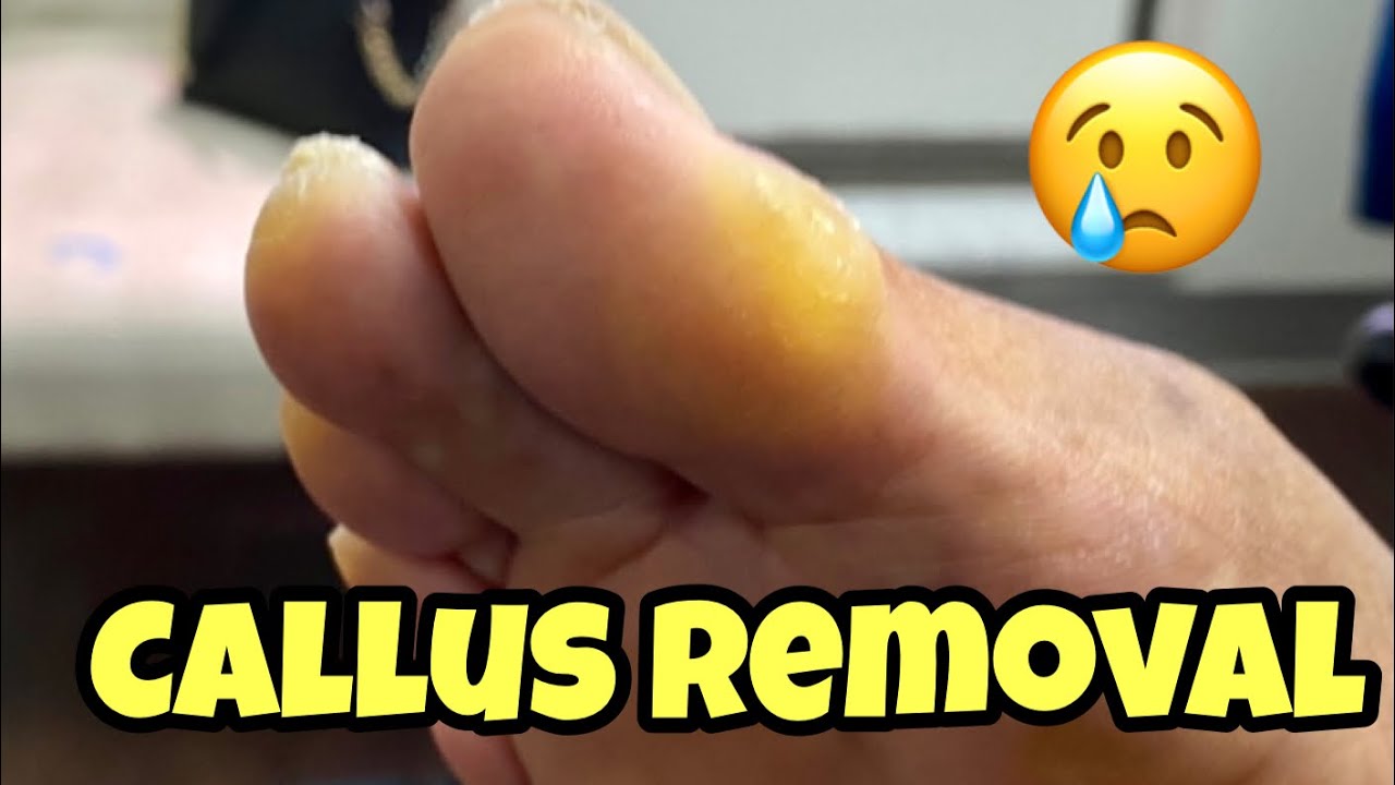 EXTREMELY SATISFYING CALLUS REMOVAL FROM THE FOOT 