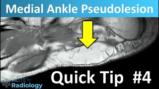 Foot Pseudotumor On Mri Msk Quick Tip 