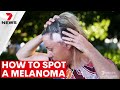 How to spot a Melanoma before it&#39;s too late | 7NEWS Spotlight