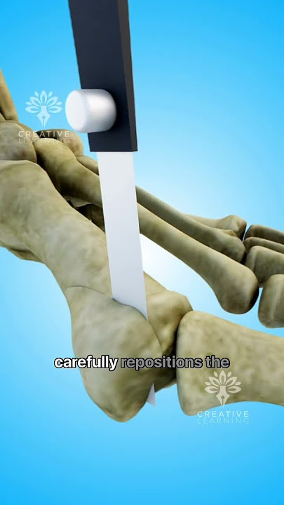How Bunion Surgery Can Transform Your Foot Health 😲 #shorts #viralvideo - Creativelearning3d