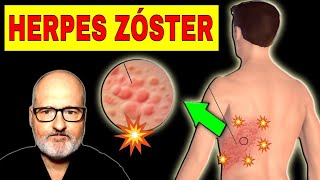 HERPES ZÓSTER (Culebrilla): Causas, Síntomas y Soluciones