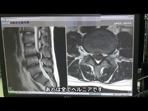 腰椎椎間板ヘルニア手術（PELD）症例解説【岩井整形外科内科病院】