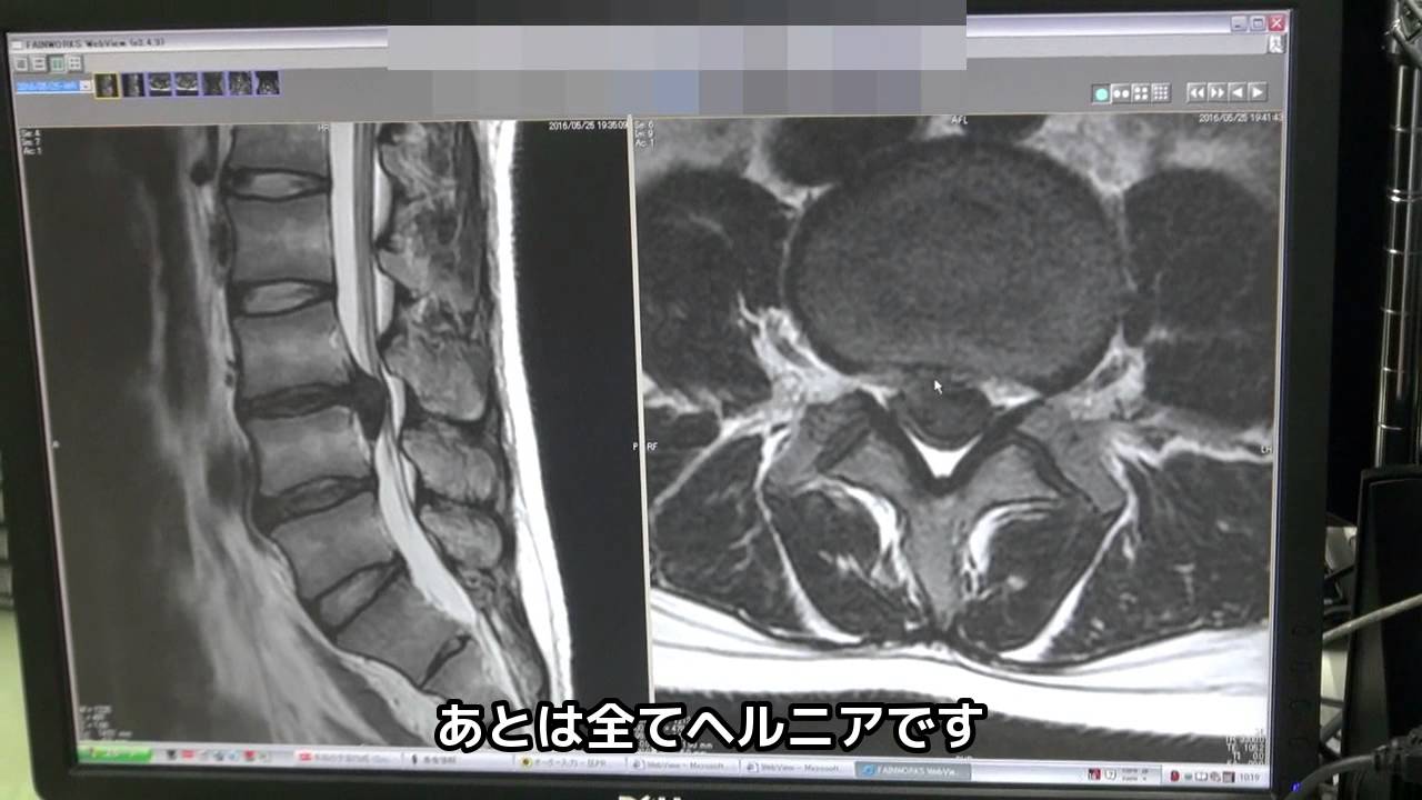 腰椎 椎間板 ヘルニア 手術 後 の 生活