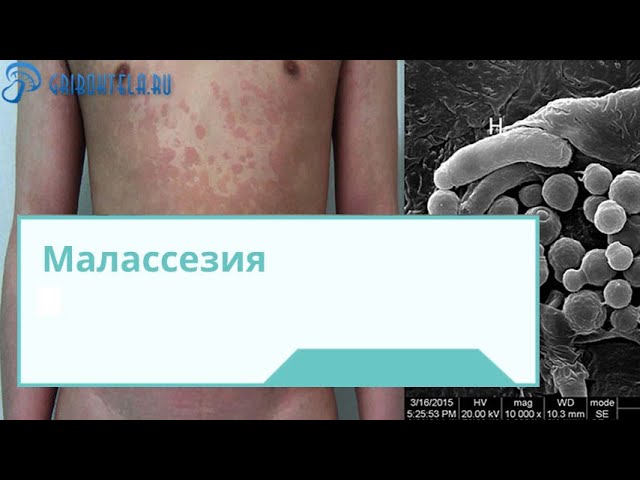 Грибок Малассезия (Malassezia): факторы развития, симптоматика, диагностика, лечение