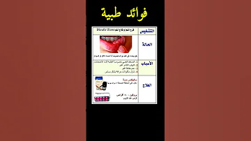 فوائد طبية مهمة و علاج لحالة تقرح الفم طب علاج دواء استشفاء فوائد 