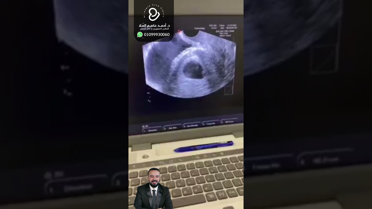 أمل جديد لحالات ضعف المخزون الشديد جدًا