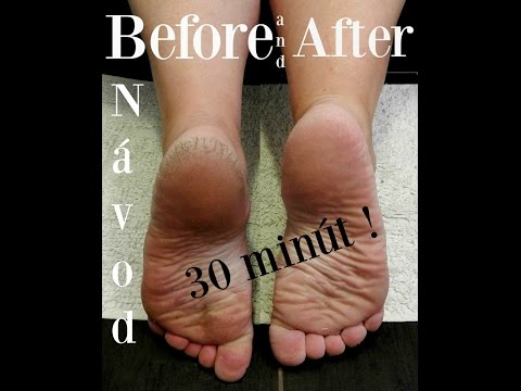 Video: 3 spôsoby, ako sa zbaviť suchej pokožky na nohách
