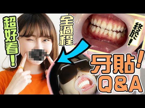 【 牙🦷 】諗咗幾年🔥 我做牙貼啦 ‼️ 過程公開！ 解答大家的疑問🔎 牙貼 Q&A❤️  幾錢？洗唔洗磨牙？ ｜譚杏藍 Hana Tam