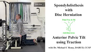 Spondylolisthesis with Disc Herniation Exercises- When &quot;Tail Under&quot; is Dangerous