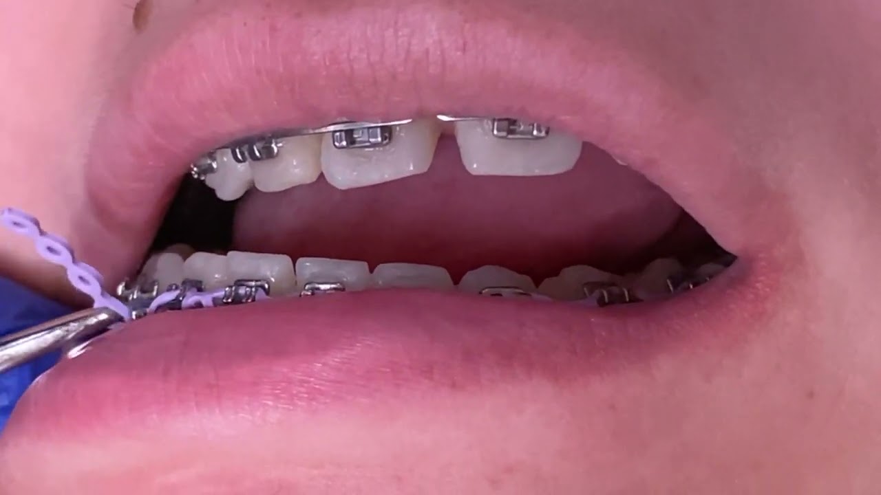 Braces checkups Power chains & Bite plate off Tooth Time Family