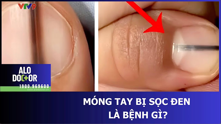 Móng tay bị kẻ sọc là bệnh gì năm 2024