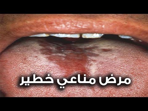 فيديو: ما الذي يسبب HLA؟