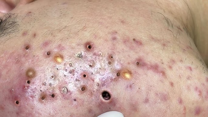 Blackheads & Acne Treatment 03.04.2024 (Part 2) - YouTube