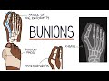 Understanding Bunions (Hallux Valgus)