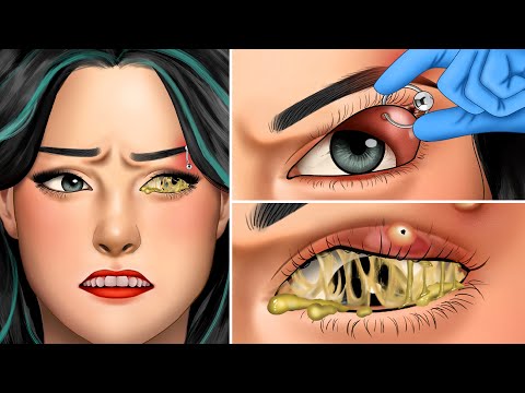 ASMR Remove unmanaged eyebrow piercing pus animation | Squeeze eyes acne