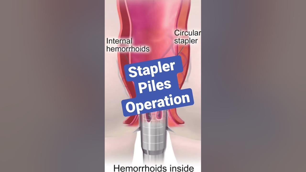 PILES OPERATION KAISE HOTA HAI ? MIPH Haemorrhoids Treatment in India ...