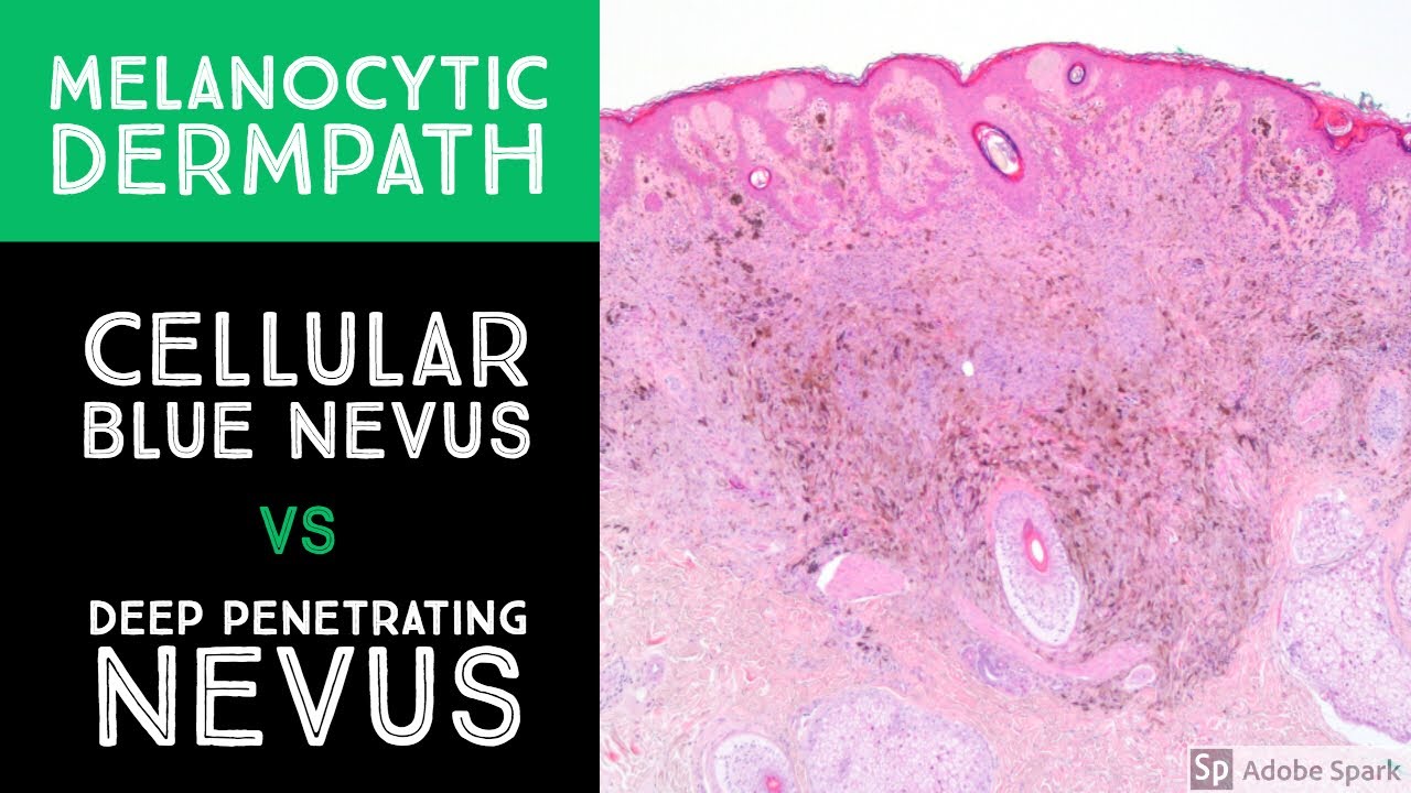 Melanocytic Dermpath Cellular Blue Nevus vs Deep Nevus