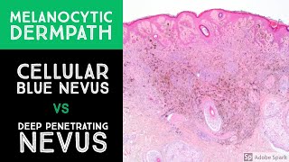 Melanocytic Dermpath: Cellular Blue Nevus vs Deep Penetrating Nevus/Melanocytoma
