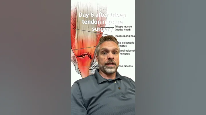 Day six after tricep tendon repair surgery. Starting to get back to normal but one hand￼
