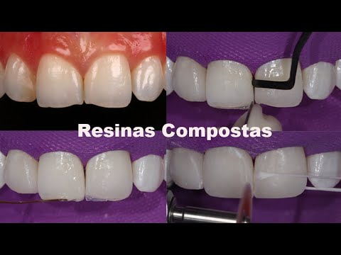 Vídeo: Restauração Dentária Estética