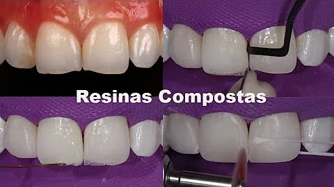 Como aumentar os dentes desgastados?