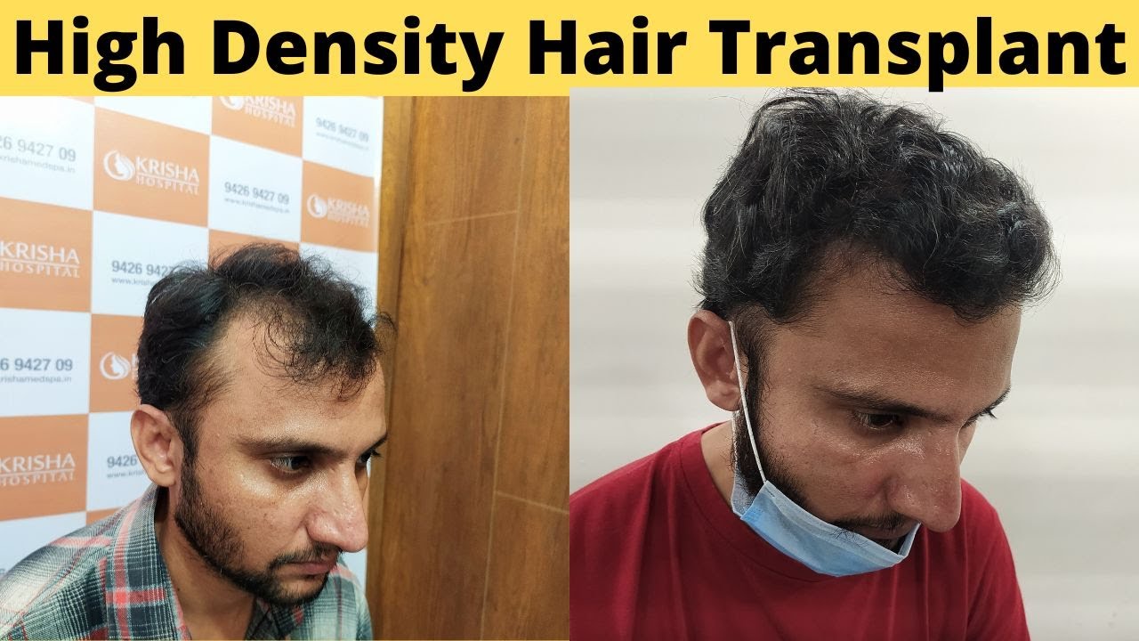 Best FUT Hair Transplant in Vadodara  Fut Hair Transplant Treatment