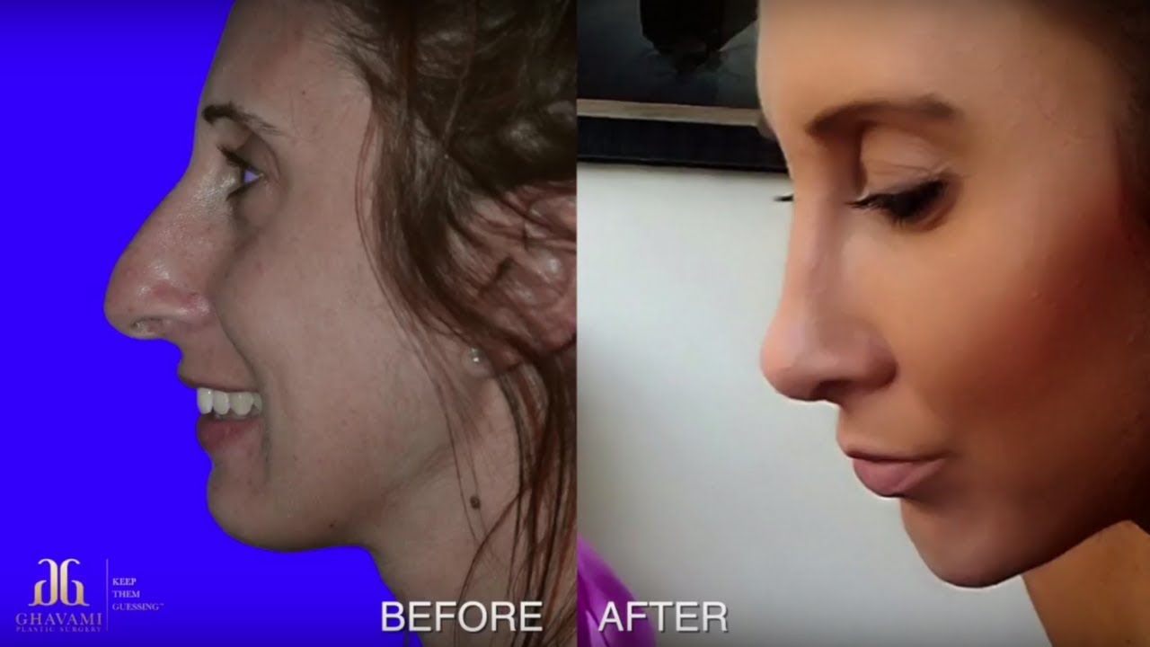 Face Surgery Before And After Transformation Dr Ghavami Youtube