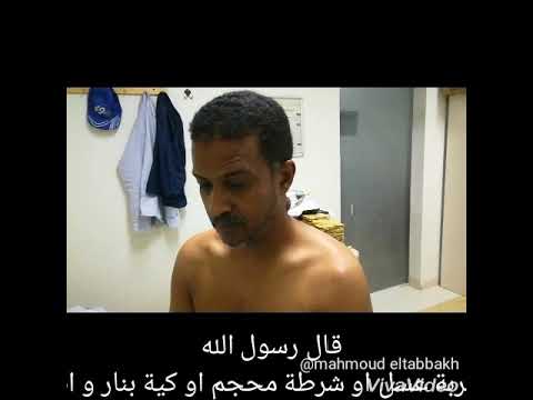 دكتور محمود الطباخ الدمام حجامة الارق و التوتر و سرعة ضربات القلب