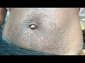 Stomach Chemical Peel (Post Baby) Full Process | Procedure | Peeling | Before & After