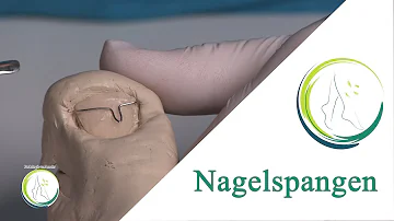 Wer darf Nagelspangen setzen?