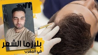 زراعة الشعر و بلازما الشعر في المغرب لعلاج الصلع الوراثي و إنبات الشعر - الفوائد والأضرار