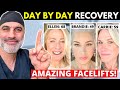 3 Face Lift Recovery Day by Day Journeys: Photos! and Videos!
