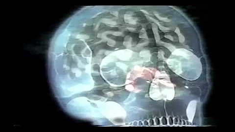 Dr. Persinger's God Helmet