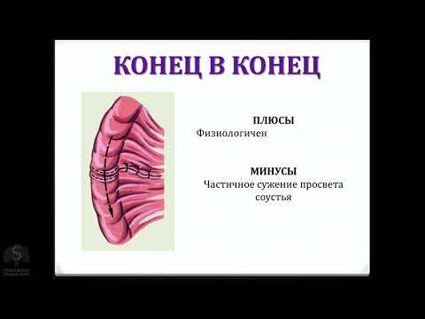 Видео: Где находится подвздошно-ободочный анастомоз?