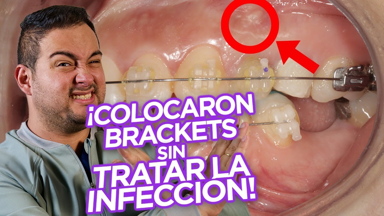 ¡BRACKETS! Ortodoncia con DIENTES con ENDODONCIA (TRATAMIENTOS DE