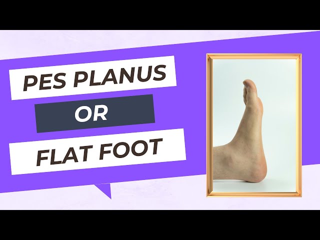 How Much Do You Know About Flexible Flat Feet? — Advanced Feet