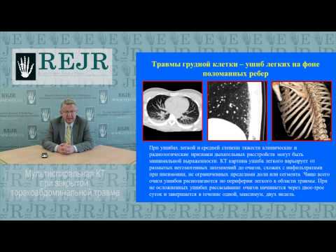 Мультиспиральная КТ в диагностике тупой торакальной и абдоминальной травмы