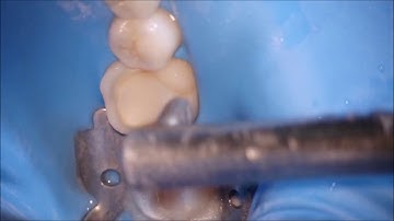 NHA KHOA MINH TRi - THẨM MỸ RẰNG PHƯƠNG PHÁP OVERLAY