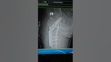 How to make x ray  left hip joint,How many types of x ray#- DHS#-Dr surgery short video#-Allah reham
