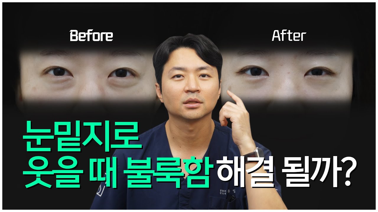 [로이성형외과] 눈밑지방재배치하면 웃을 때 너무 볼록한게 좋아지나요?
