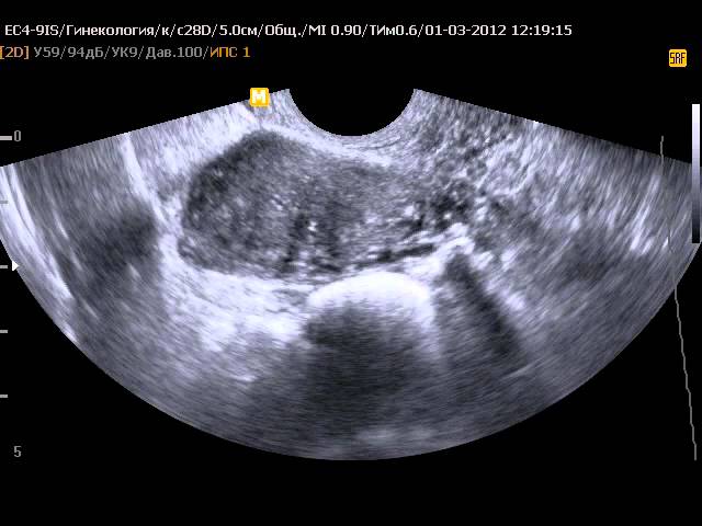 Рудиментарный рог матки