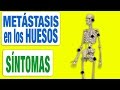 Todos los Síntomas de las Metástasis en los Huesos