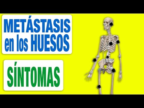 Vídeo: Cáncer Extendido A Los Huesos: Esperanza De Vida, Tratamiento, Tipos