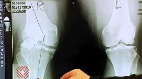 Total Knee Replacement Part 2: Symptoms & Evaluation