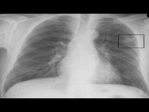 Wideo: Co To Jest Kaszel Z Rakiem Płuc? Opis, Diagnoza I Zarządzanie